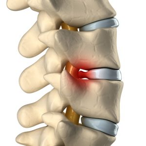 spine herniated disc